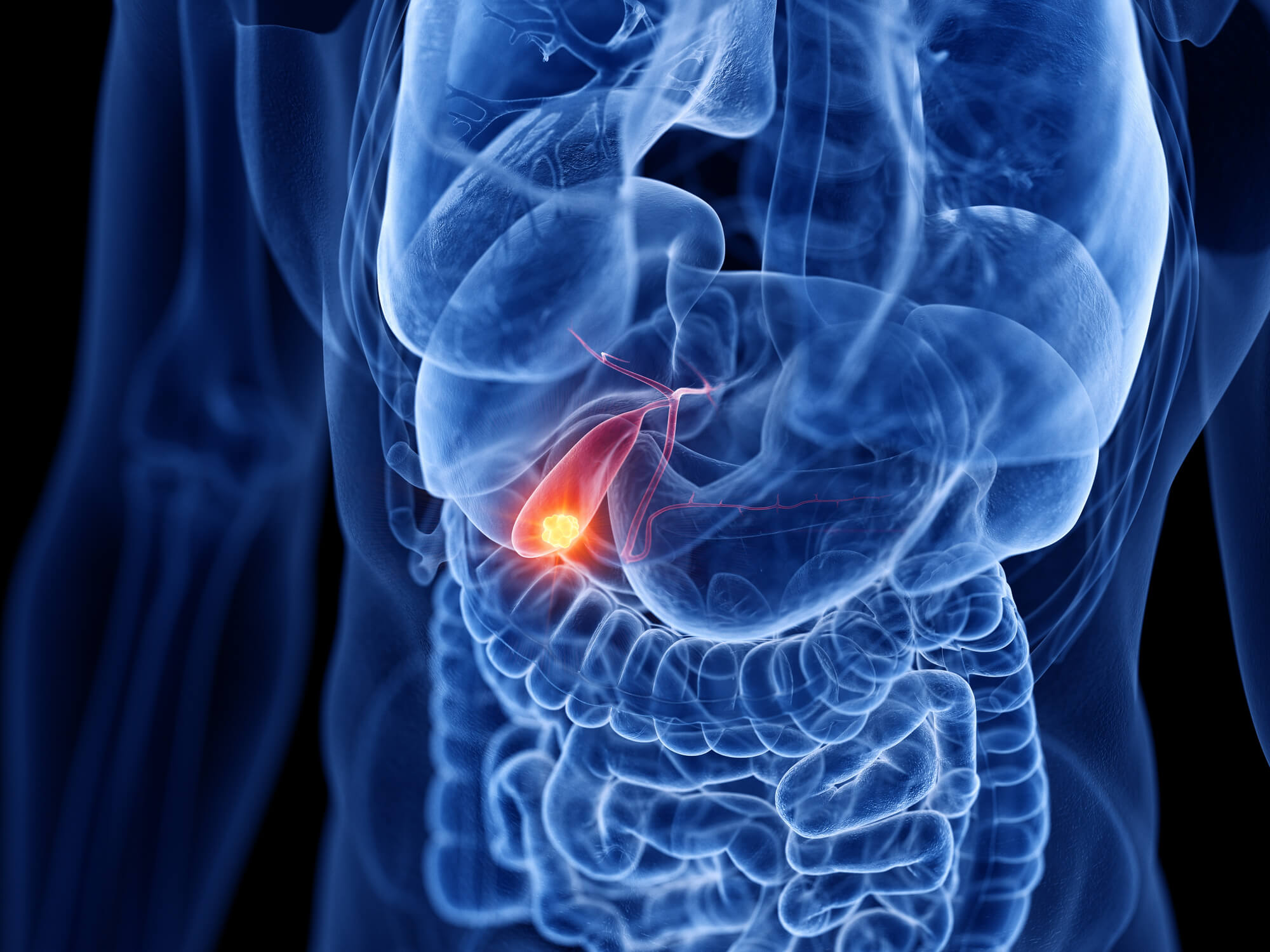 Gallbladder Cancer