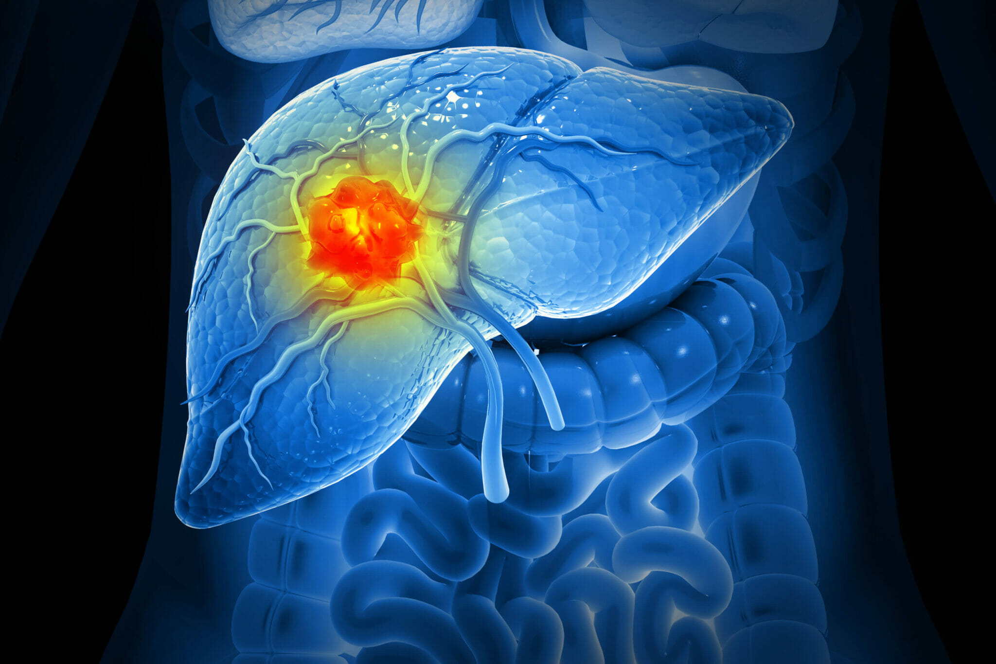 Liver Cancer